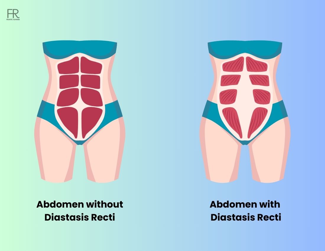 Running With Diastasis Recti Must Know Facts Safety Tips