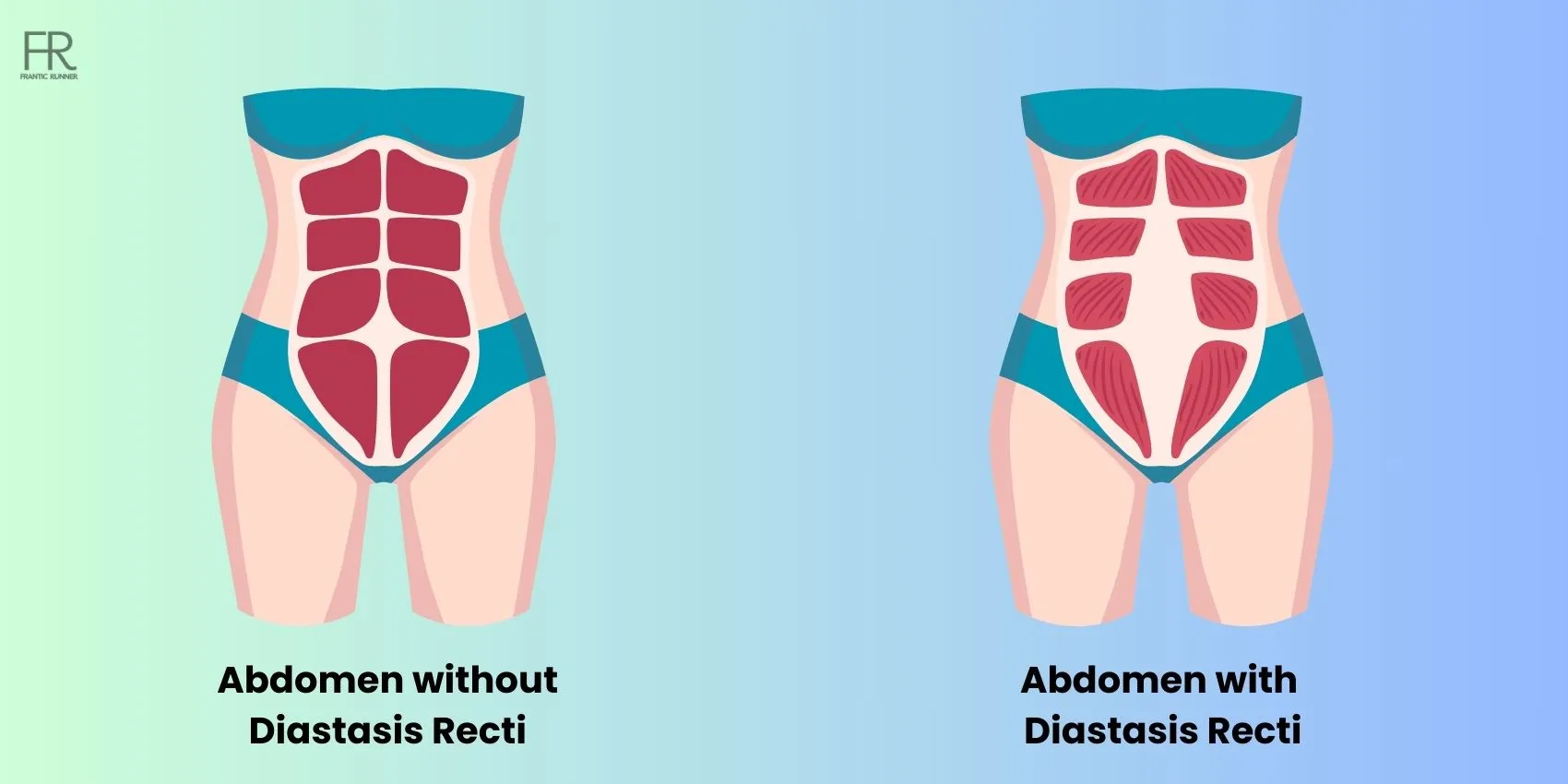 Image showcasing a abdomen without diastasis recti alongside with another abdomen suffering with diastasis recti