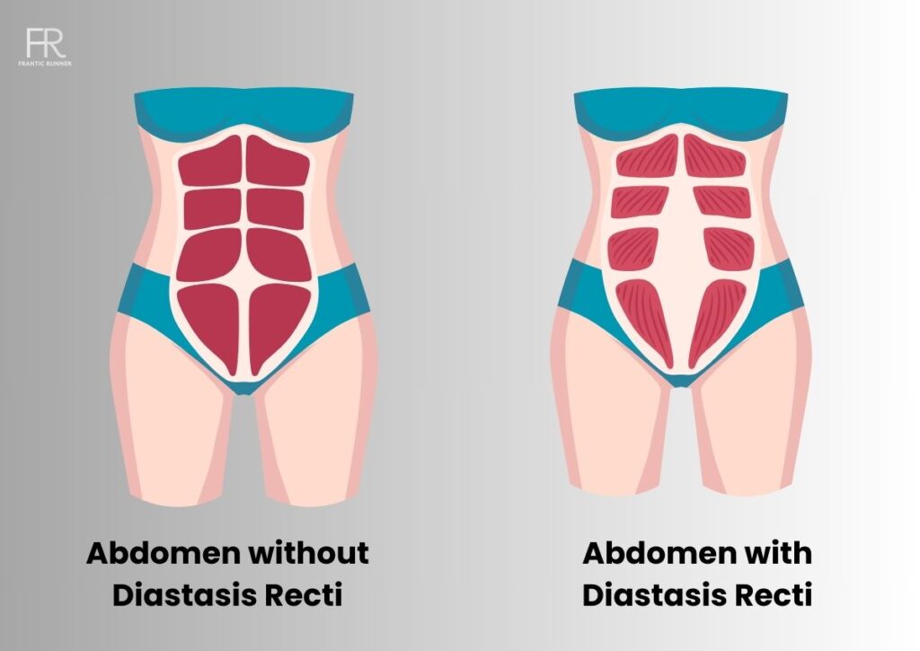 Image showcasing a abdomen without diastasis recti alongside with another abdomen suffering with diastasis recti