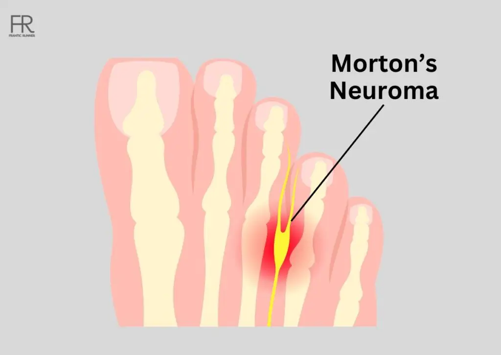 foot Image explaining the Morton's Neuroma pain