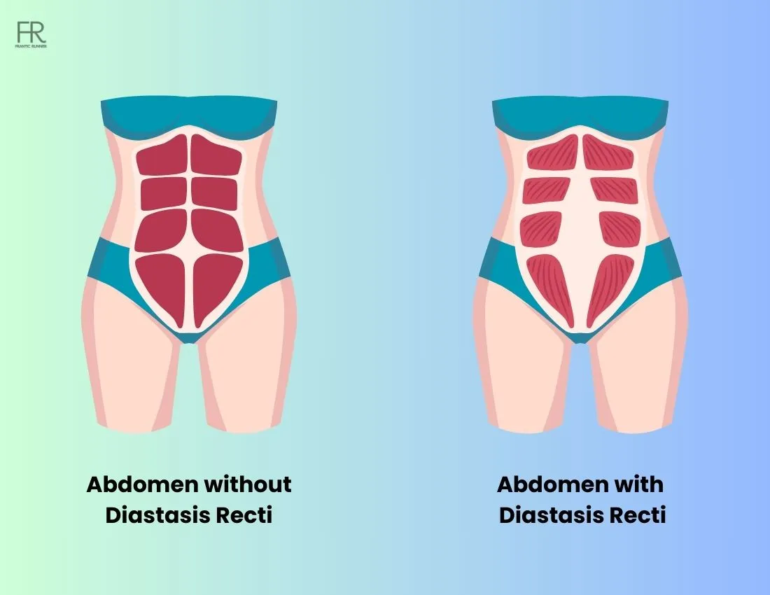 an Image showcasing a abdomen without diastasis recti alongside with another abdomen suffering with diastasis recti