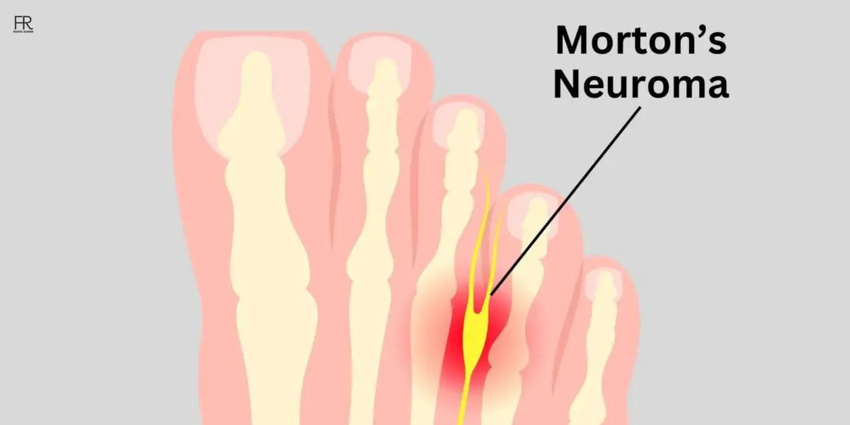 an image showing running with Morton's neuroma