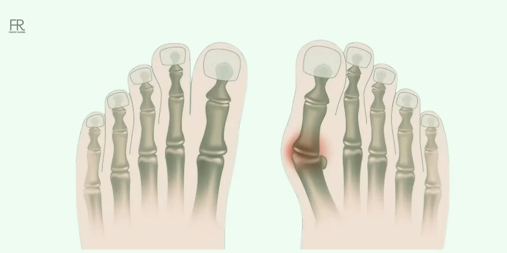 an image showcasing running with bunions