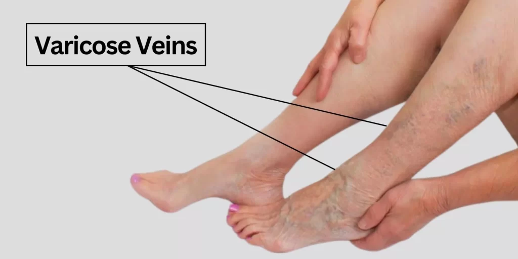 Can Running cause varicose veins