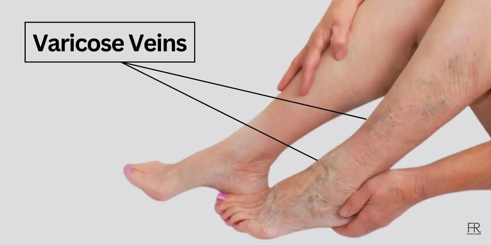 can running cause varicose veins